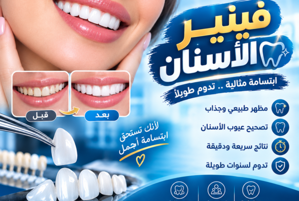 فينير الأسنان