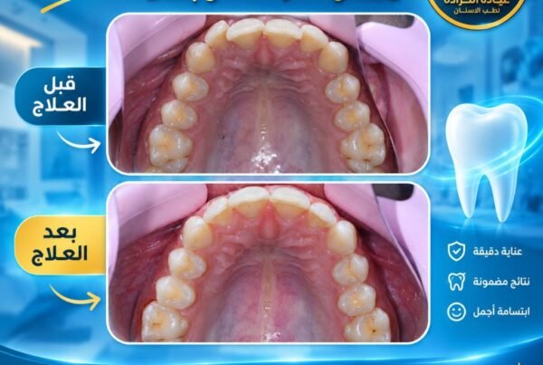نتائج قبل وبعد علاج وتجميل الأسنان عيادة الكرادة