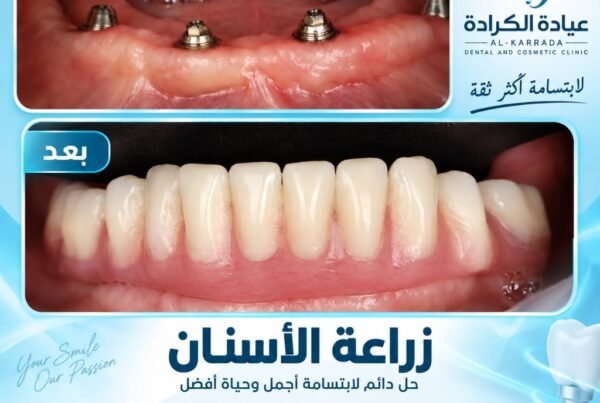 حالة زراعة وتأهيل الفك الكامل بالزراعة الألمانية All-on-4 قبل وبعد عيادة الكرادة دكتور بسام الجبوري