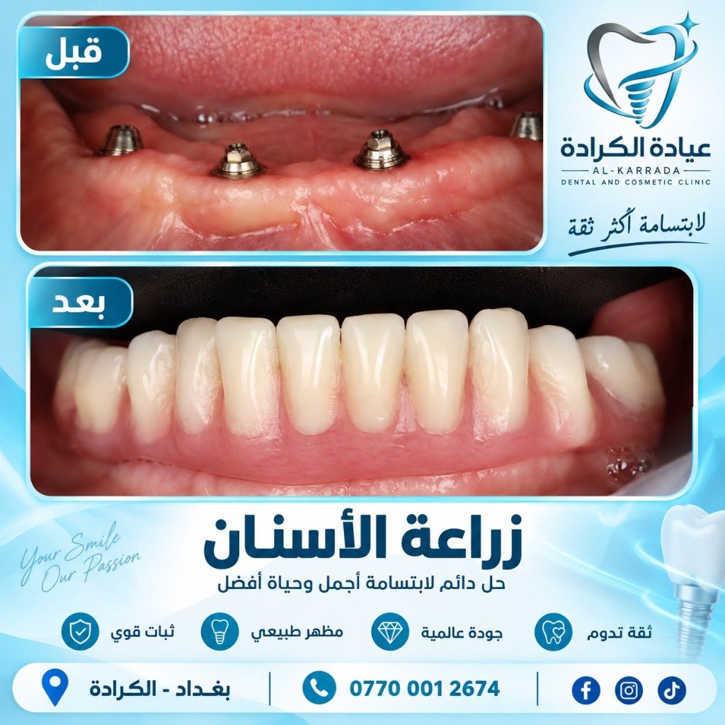 حالة زراعة وتأهيل الفك الكامل بالزراعة الألمانية All-on-4 قبل وبعد عيادة الكرادة دكتور بسام الجبوري