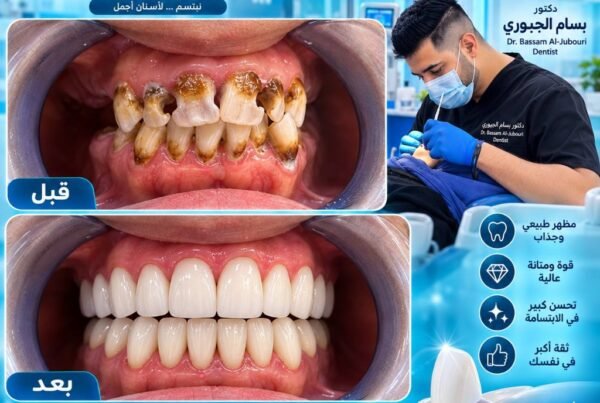 تغليفات الزركون قبل وبعد دكتور بسام الجبوري